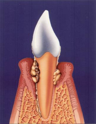Zahn im Knochenfach mit Konkrementen Belägen und Parodontitis